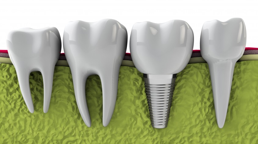 dental implants Coral Springs