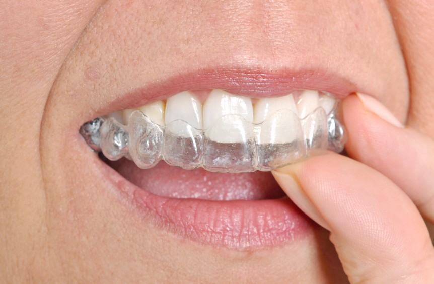 Invisalign Coral Springs