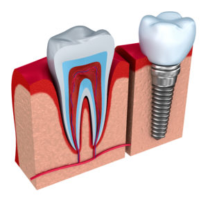 dental implants Fort Lauderdale